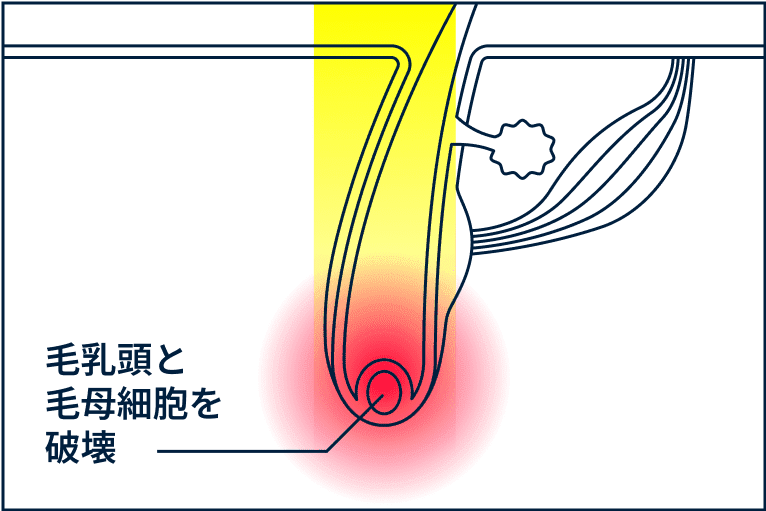 深部にエネルギーが到達し ヒゲの根深い毛に効果的