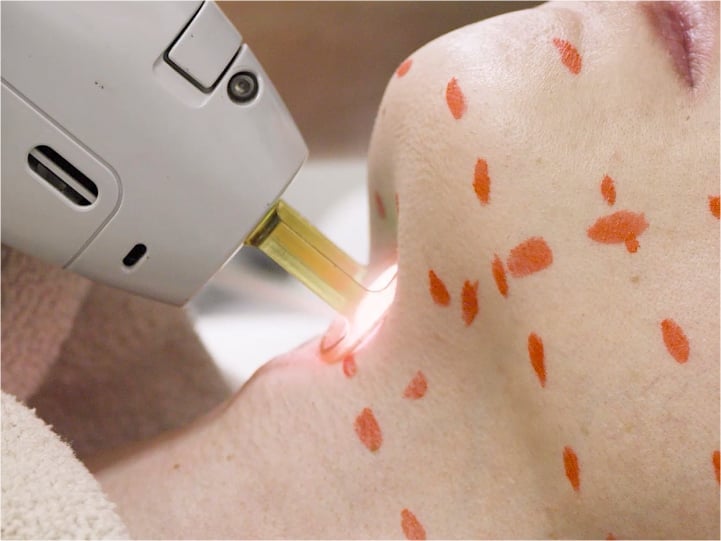 ヒゲ脱毛の照射風景