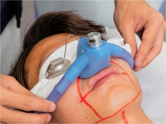 吸う麻酔 笑気ガス麻酔