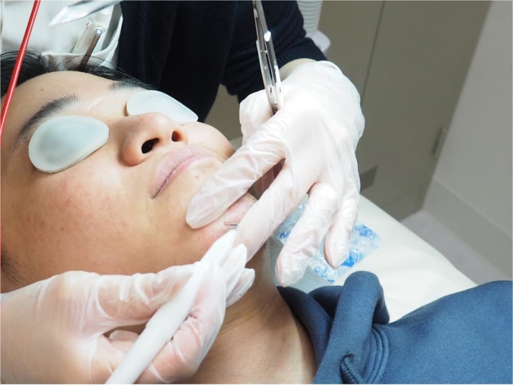 ヒゲのニードル脱毛の施術風景