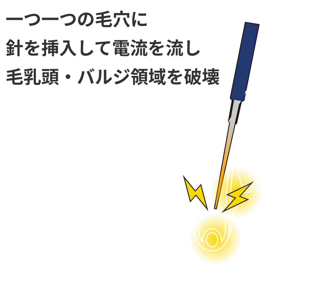 一つ一つの毛穴に針を挿入して電流を流し毛乳頭・バルジ領域を破壊