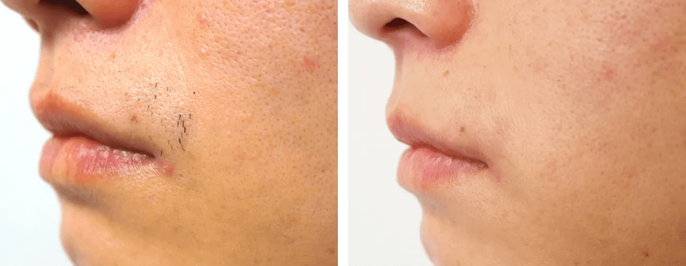 ニードル脱毛の症例写真