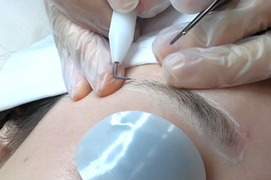 レーザーだけじゃない仕上げに最適なニードル脱毛