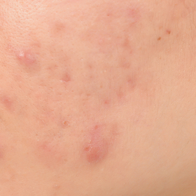 赤みのあるニキビ跡