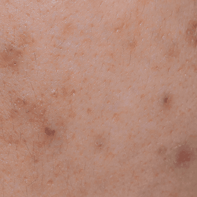 シミのようなニキビ跡