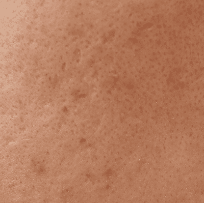 凸凹したニキビ跡