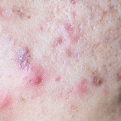 ケロイド状のニキビ跡