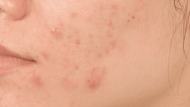 赤みのあるニキビ跡