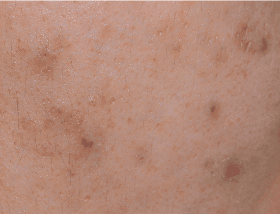 シミのようなニキビ跡