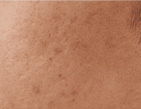 凸凹したニキビ跡