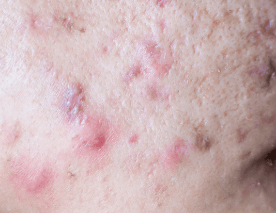 ケロイド状のニキビ跡