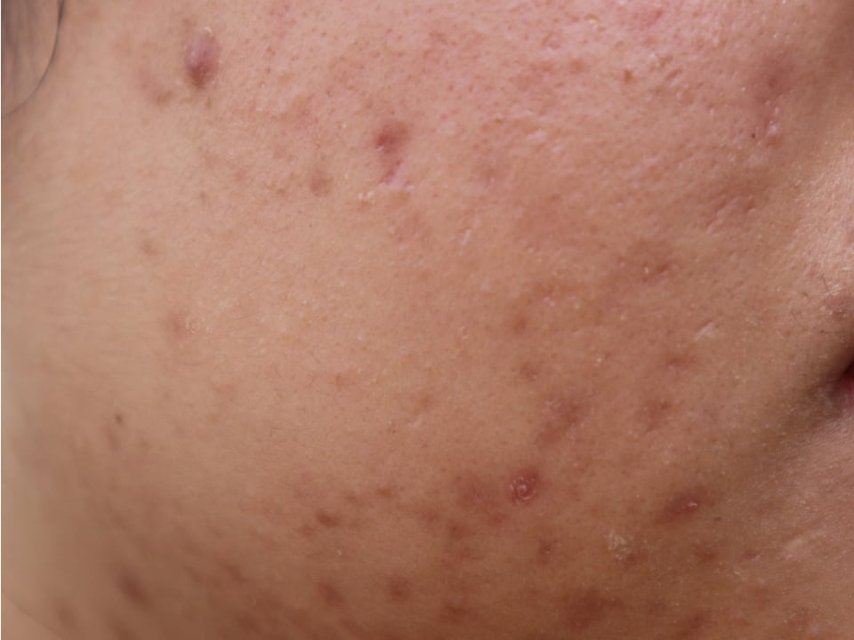 複合的なニキビ跡