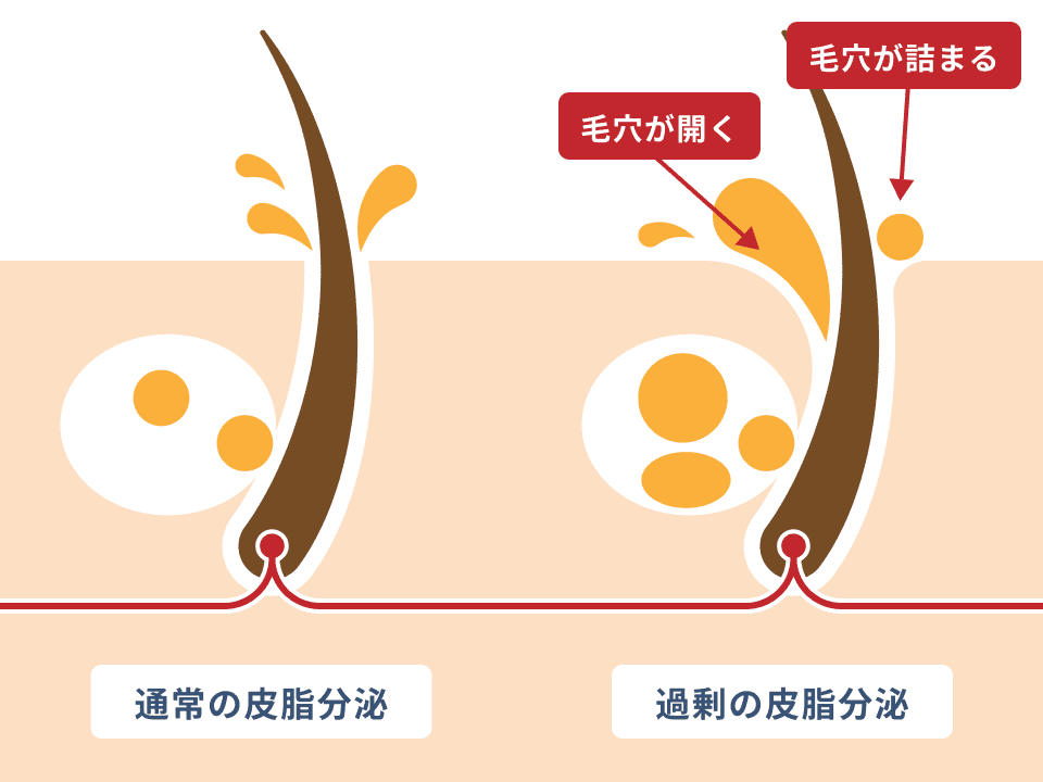 過剰の皮脂分泌について