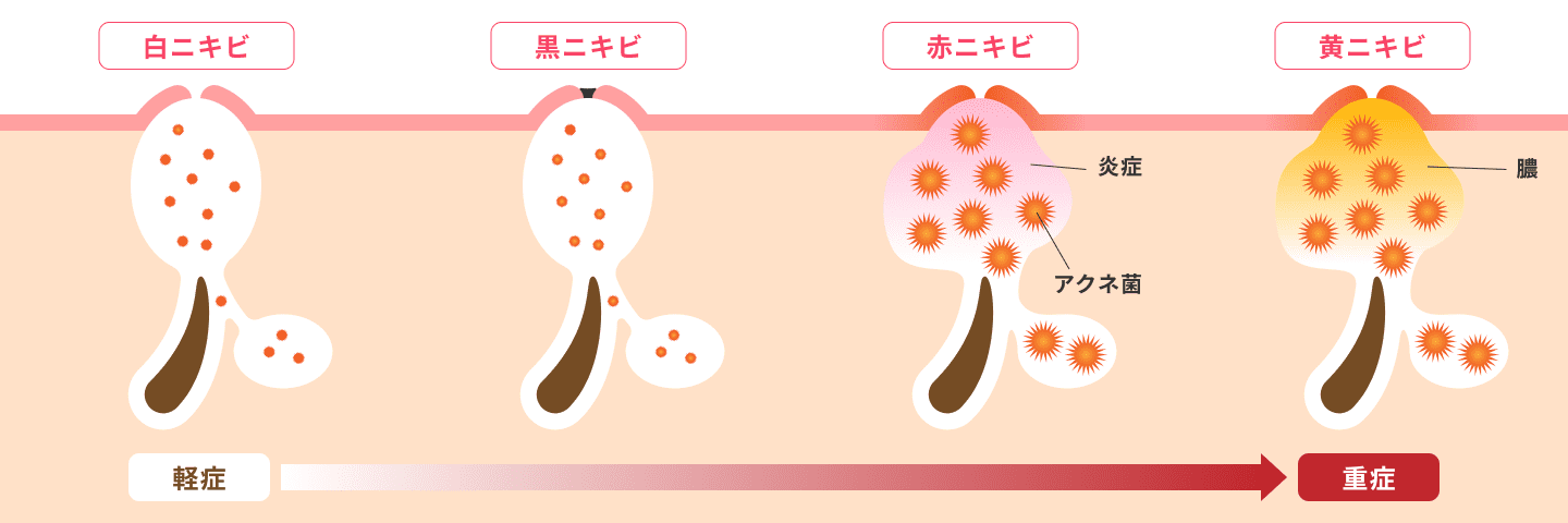 重症化したニキビが原因となり 色素沈着やクレーターなどのニキビ跡へ