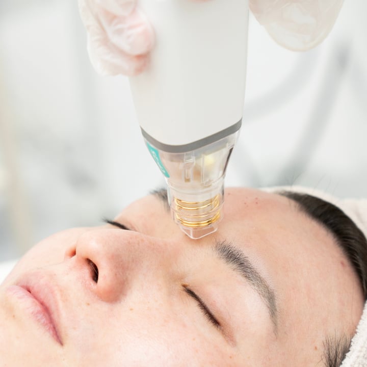 ニキビ跡・クレーター治療