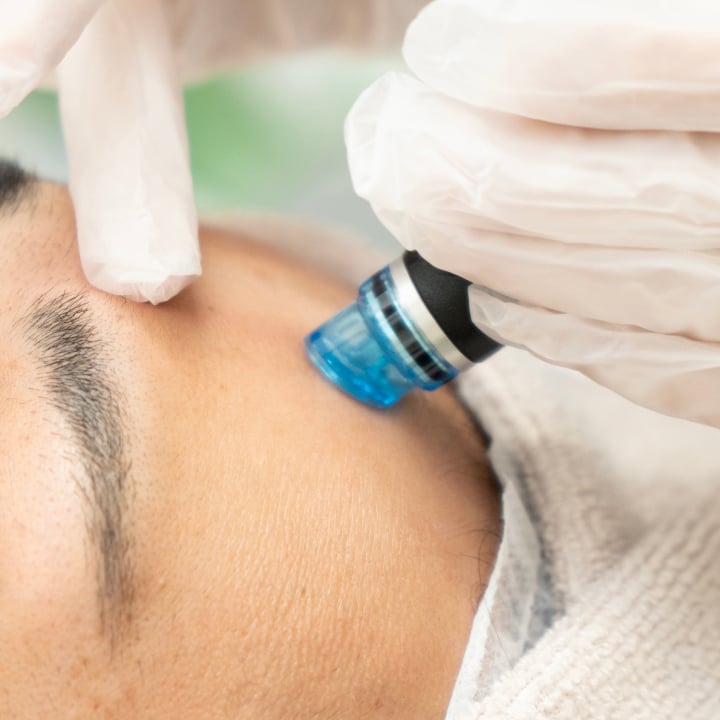 ピーリング治療