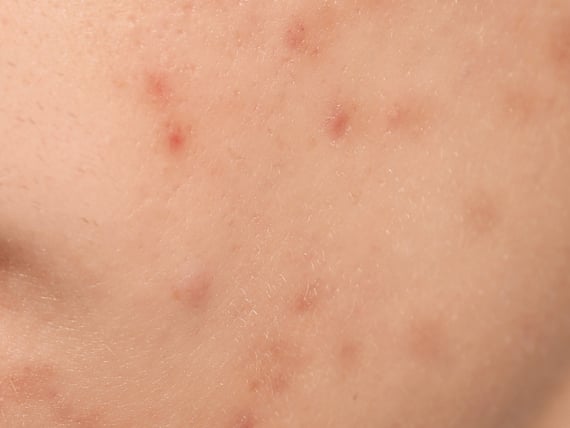 炎症後色素沈着