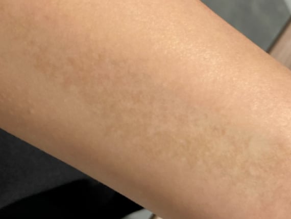 ADM(後天性真皮メラノサイトーシス)