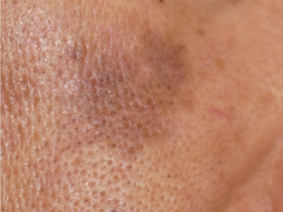 毛穴トラブルは医療機関での治療が効果的