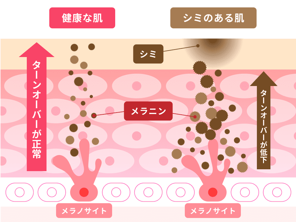 男性のシミ治療について