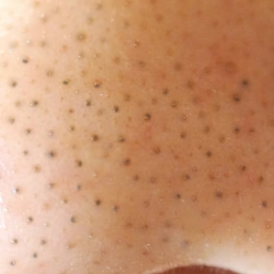 開き毛穴・黒ずみ毛穴