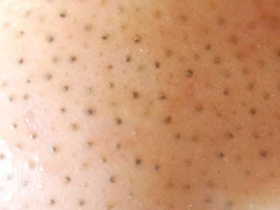 詰まり毛穴(黒ずみ)