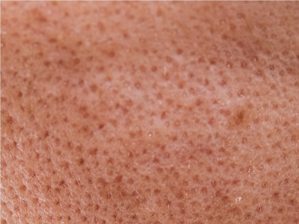 毛穴トラブルは医療機関での治療が効果的