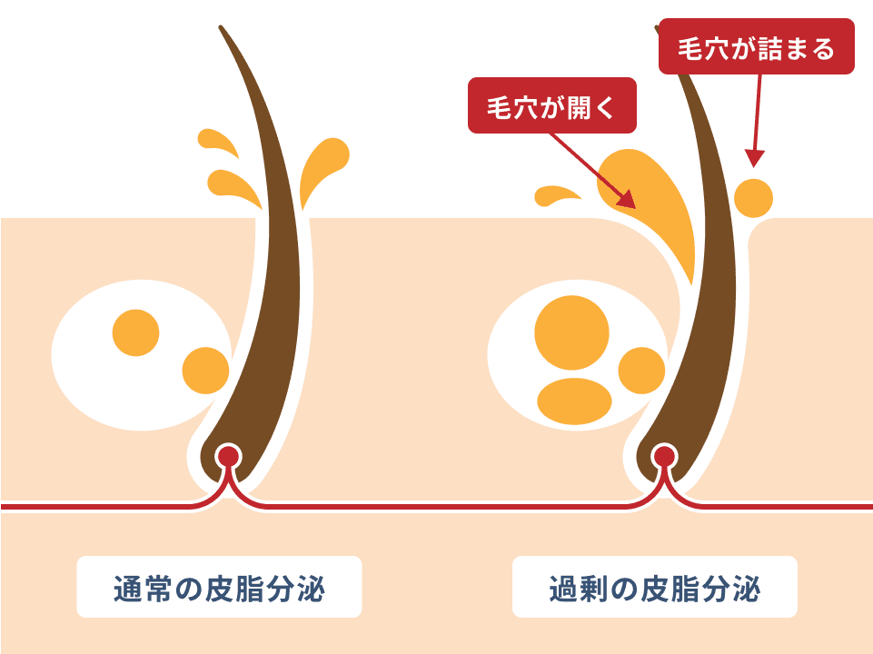 男性の毛穴治療について