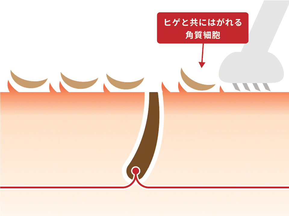 男性の毛穴治療について