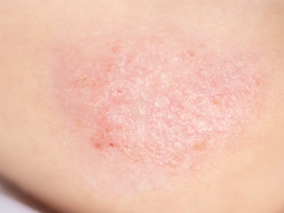 敏感肌型赤ら顔