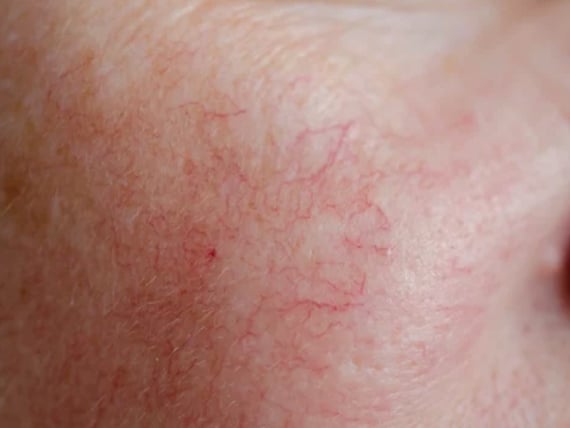 血管拡張型赤ら顔